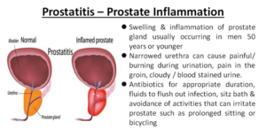 Prostatitis: foods and medicinal plants for inflammation of the ...